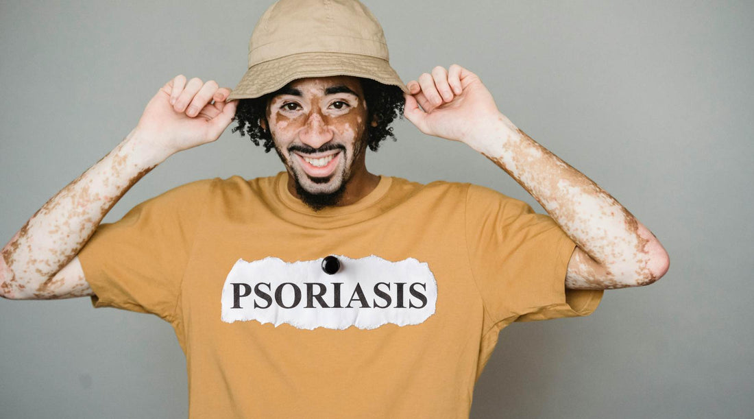 Psoriasis TShirt Relief from Chaga